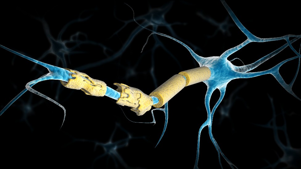 Illustration of damaged myelin in a neuron from a person with multiple sclerosis