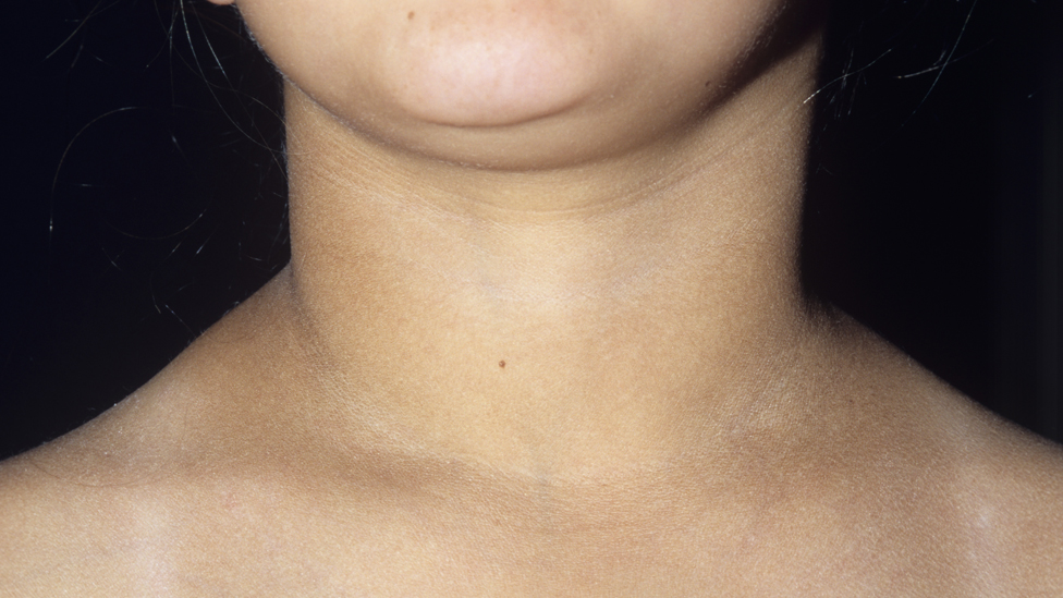 Goitre (swollen neck) of a 10- year-old girl with hypothyroidism