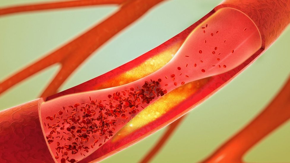 La aterosclerosis coronaria es el endurecimiento que se produce en las paredes de las arterias con la acumulación de grasa, colesterol y otras sustancias. Arteria