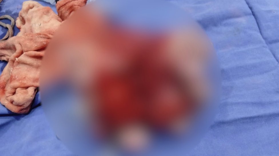 Zamućena fotografija fetusa uklonjenog iz Šazije