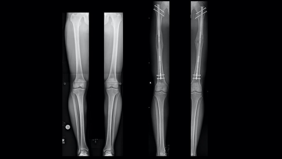 X-rays of Sam's legs before and after (right) the operation