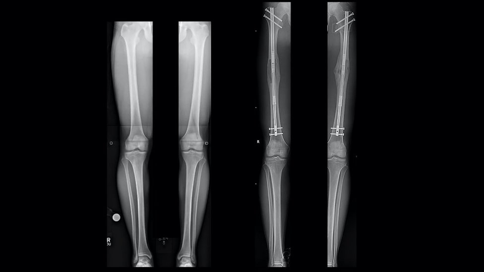 Рентгеновские снимки ног Сэма до и после (справа) операции