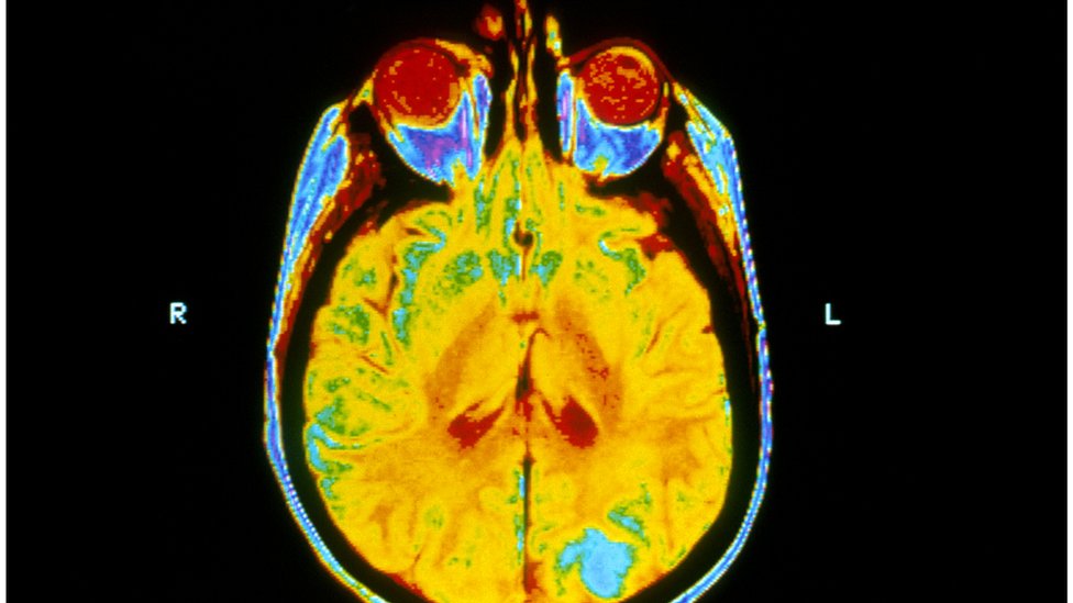 Brain radiotherapy 'no benefit' for lung cancer spread