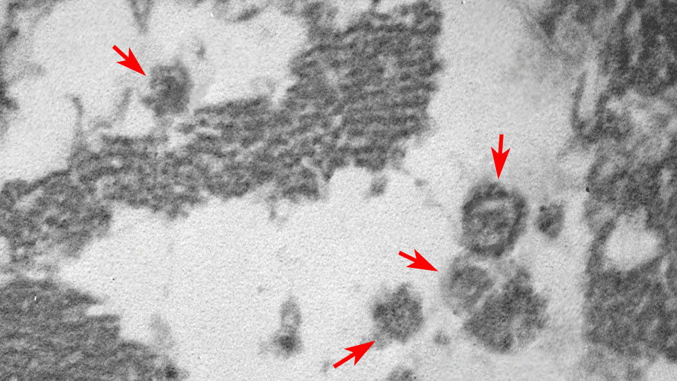 Vírus Sars-CoV-2 no interior de célula muscular cardíaca da criança
