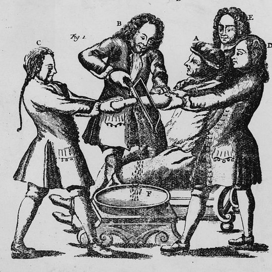 Grabado de una amputación en el siglo XVII