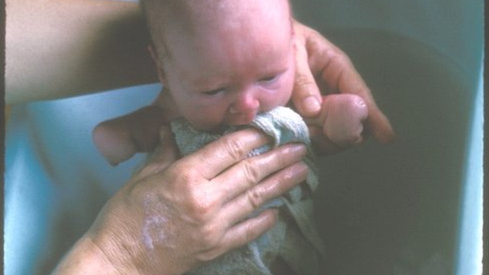 Лиза Макманус в младенчестве в ванне с укороченными руками