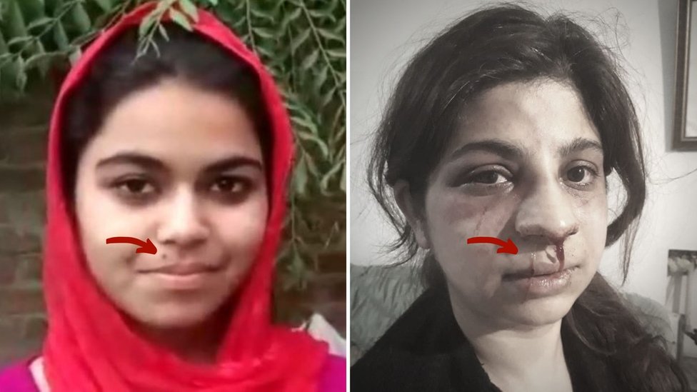 क्या ये 'लव-जिहाद' का शिकार हुई लड़की की तस्वीर है? फ़ैक्ट चेक - BBC News हिंदी