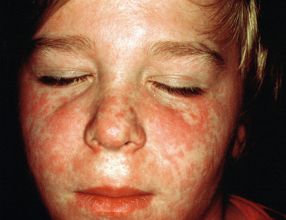 Un niño con la cara llena de ronchas por una infección de sarampión