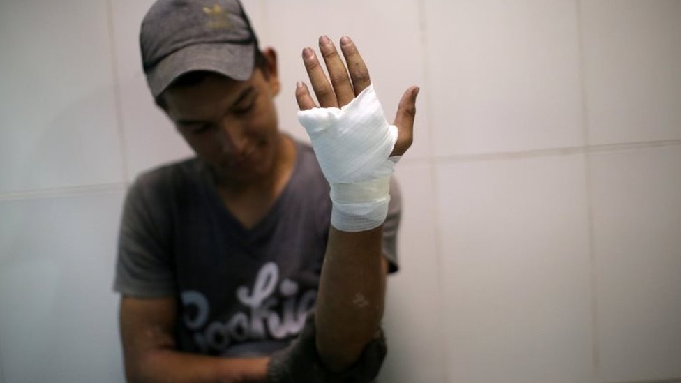 A protester holds up an injured and bandaged hand