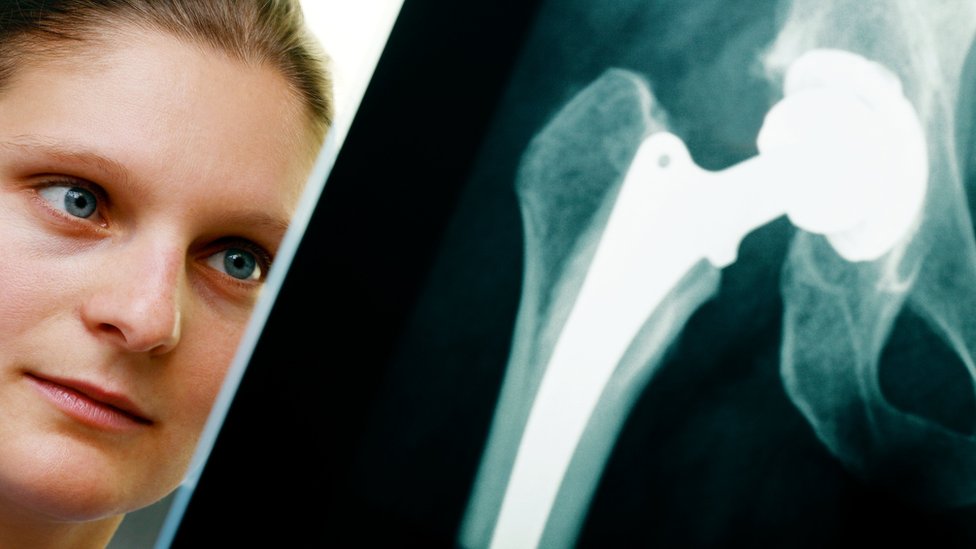женщина изучает рентген замены тазобедренного сустава