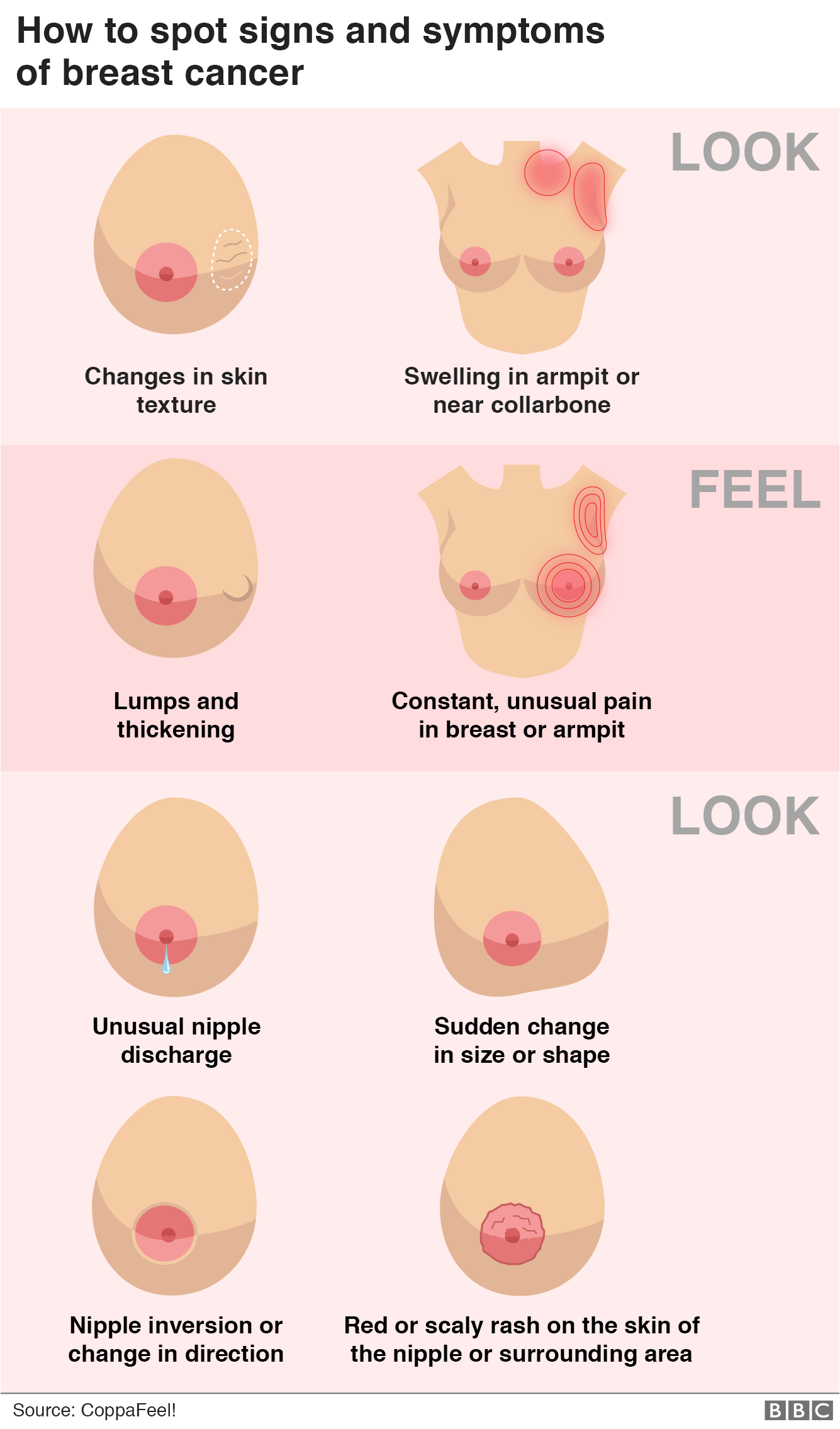 Графика, показывающая, как определить признаки и симптомы рака груди