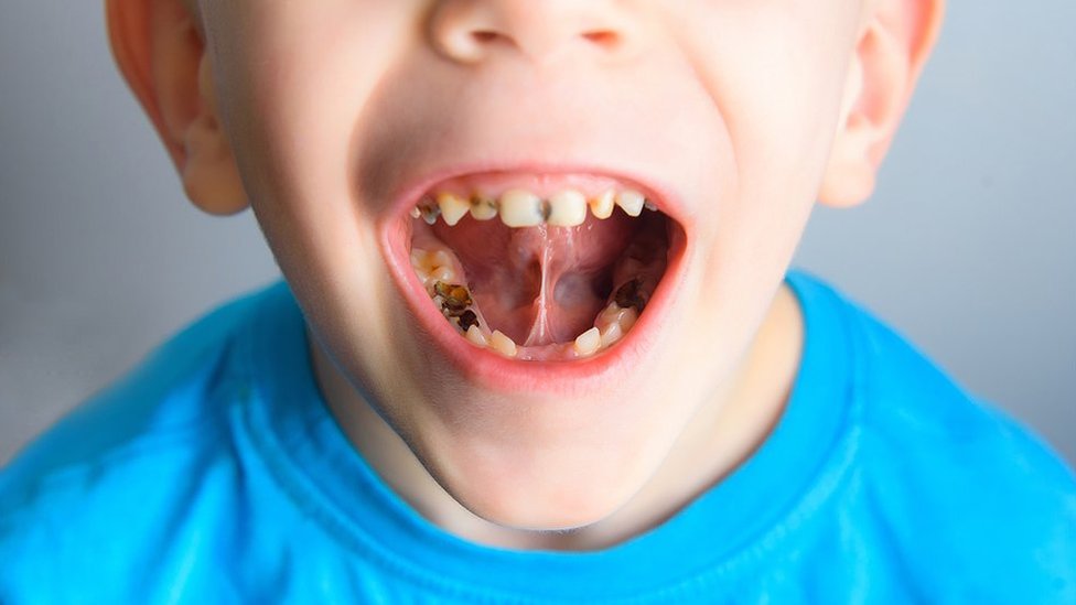 Niño con caries