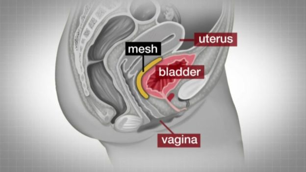 схема вагинального сетчатого имплантата