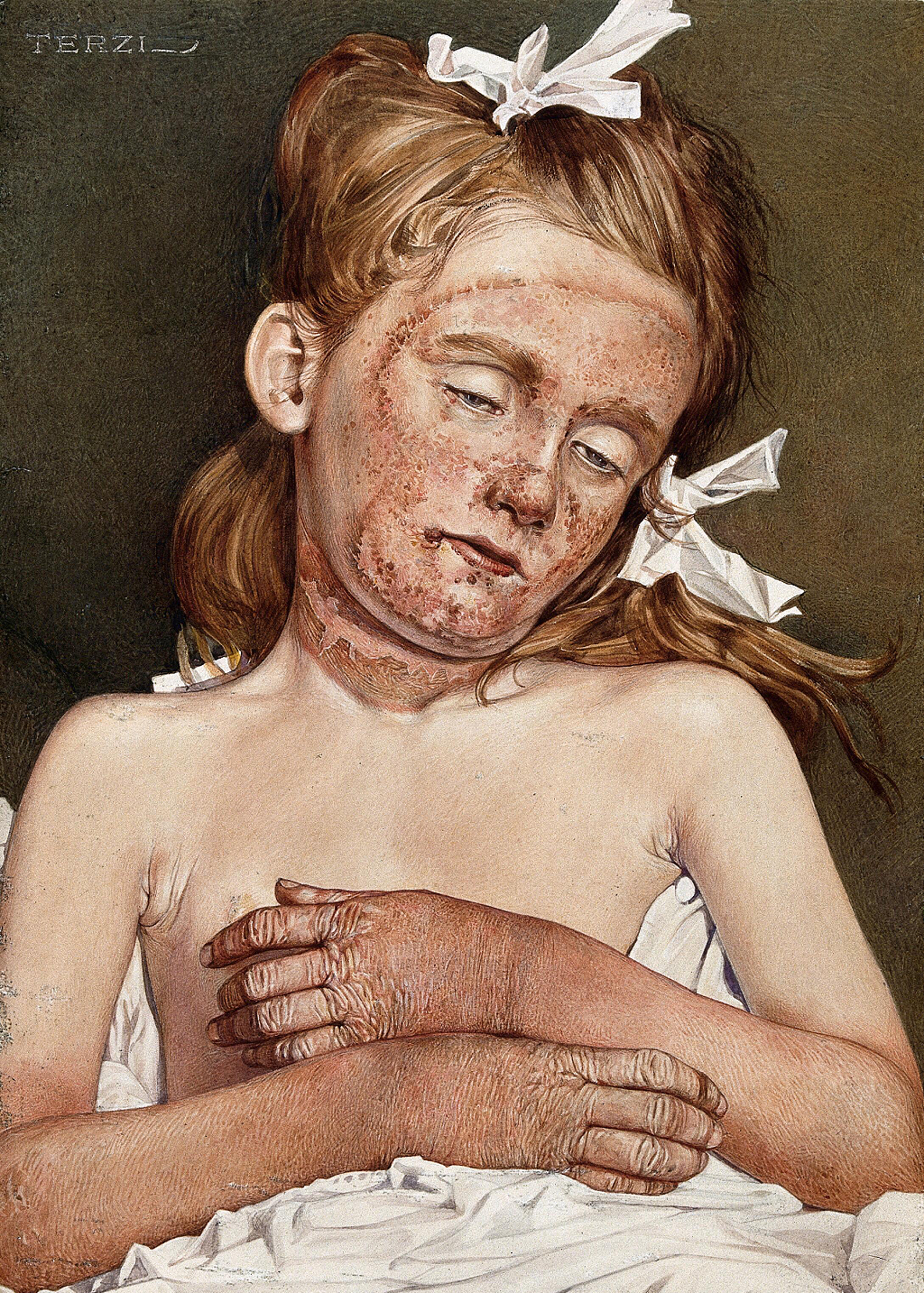 "Una niña en el asilo de Londres que sufre de pelagra crónica". Acuarela de A.J.E. Terzi, 1925.