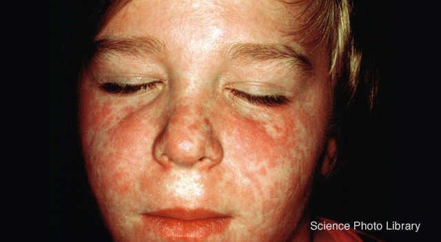Image of child infected with measles