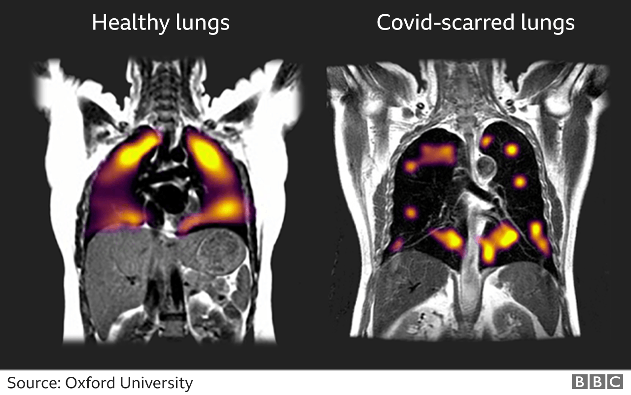 Imagens ativadas por gás de xenônio mostrando pulmões saudáveis e pulmões com cicatrizes de covid