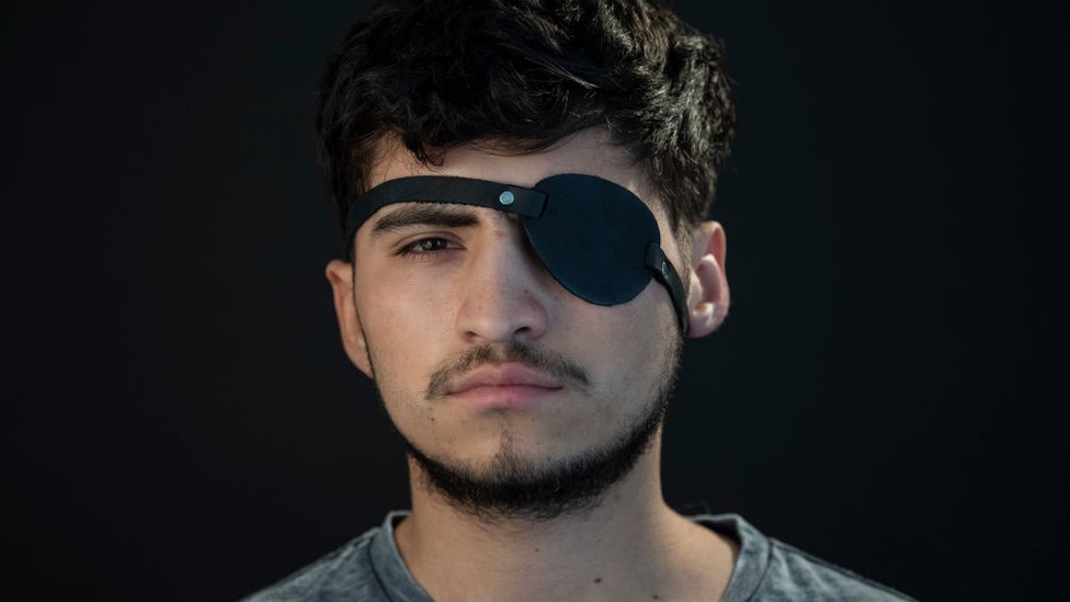 Uno de los heridos en un ojo durante las manifestaciones fotografiado con un parche en un ojo.