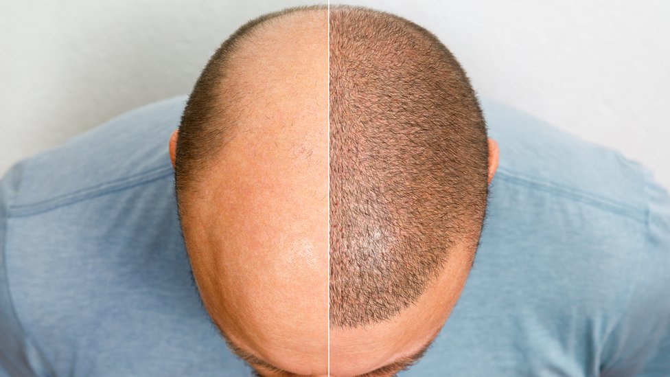 La cabeza de una persona antes y después de un transplante.