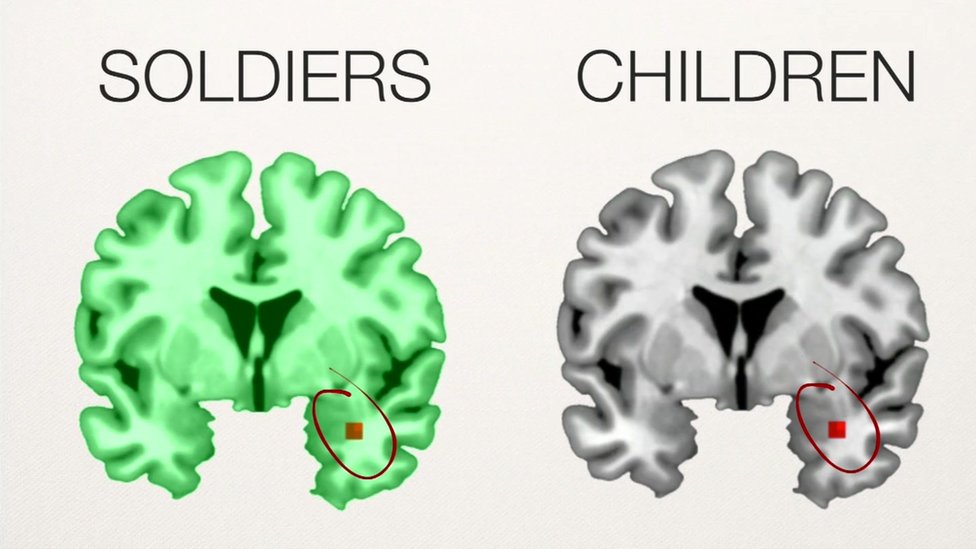 Scientists say that the brain structures of traumatised soldiers and children change in the same way.