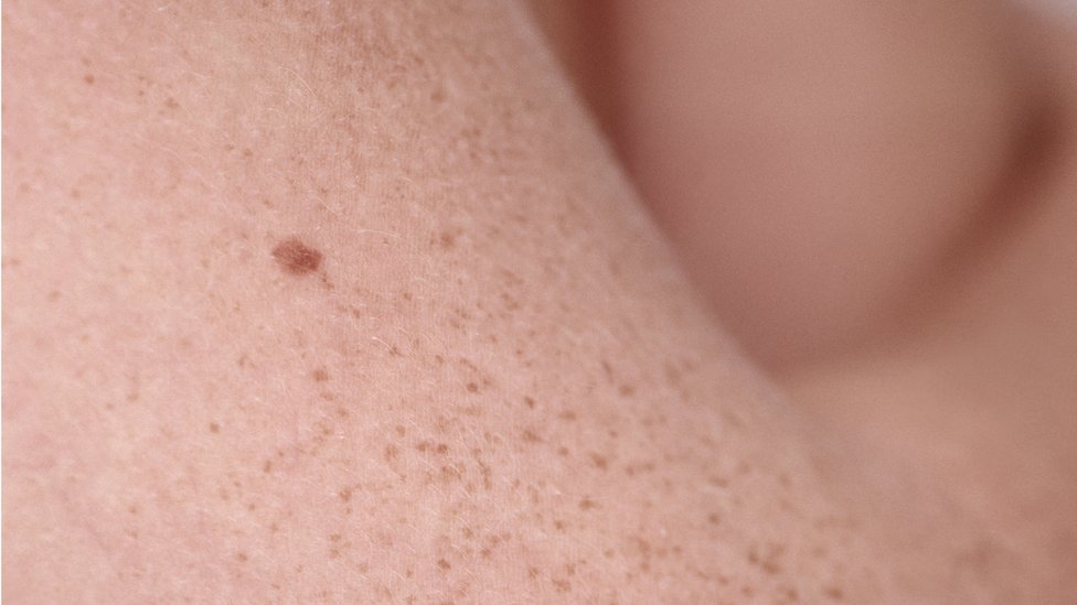 Arm Mole Count Predicts Skin Cancer Risk Bbc News 