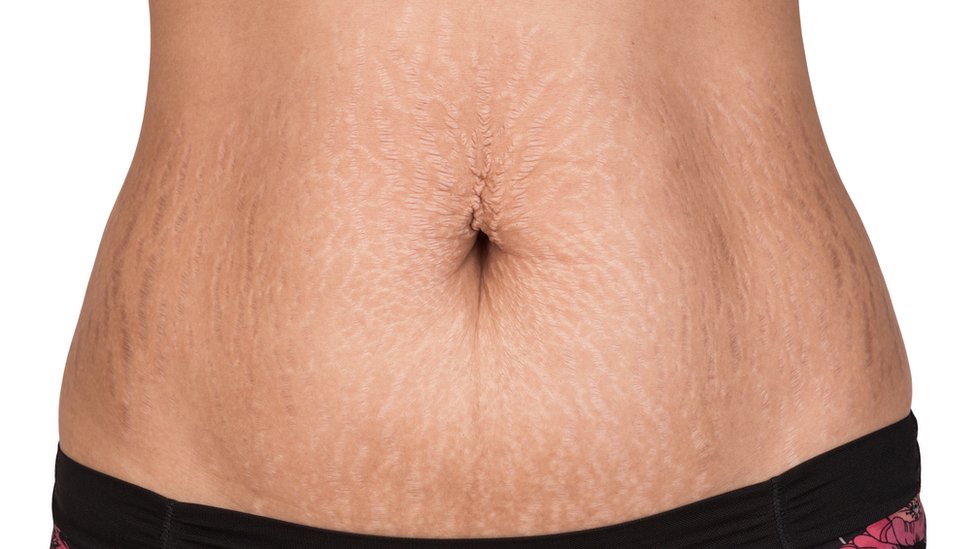 What Are Stretch Marks And Can You Prevent Them Bbc News