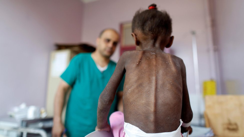 طفل يتلقى العلاج الطبي في اليمن