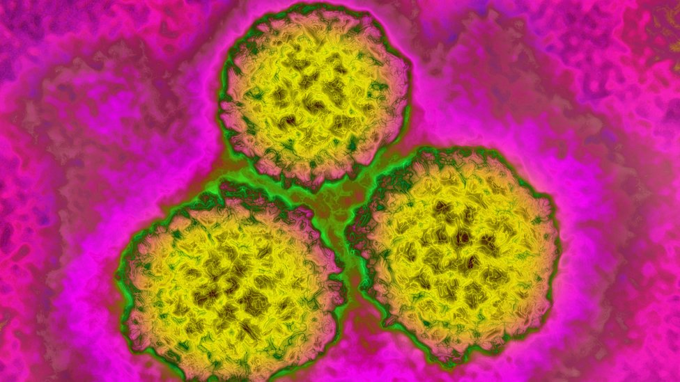 Вирус папилломы, ВПЧ). Это вызывает рак шейки матки. Изображение получено с помощью просвечивающей электронной микроскопии.