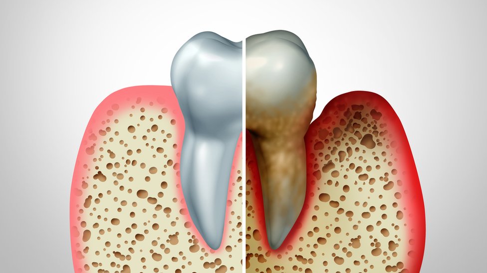 A la izquierda un diente normal, a la derecha uno cubierto de placa que ha provocado inflación en las encías.