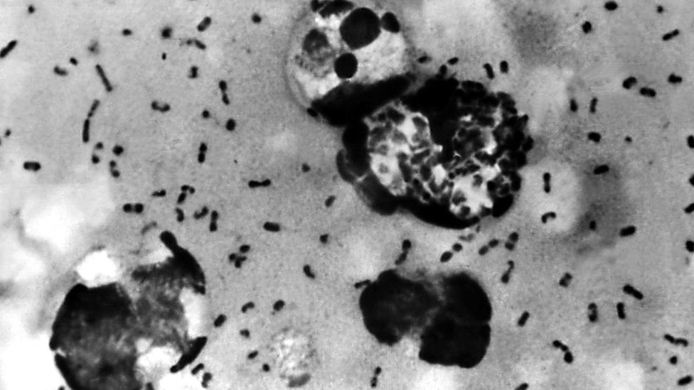 A bubonic plague smear, prepared from a lymph removed from an adenopathic lymph node, or bubo, of a plague patient, demonstrates the presence of the Yersinia pestis bacteria that causes the plague in this undated photo.