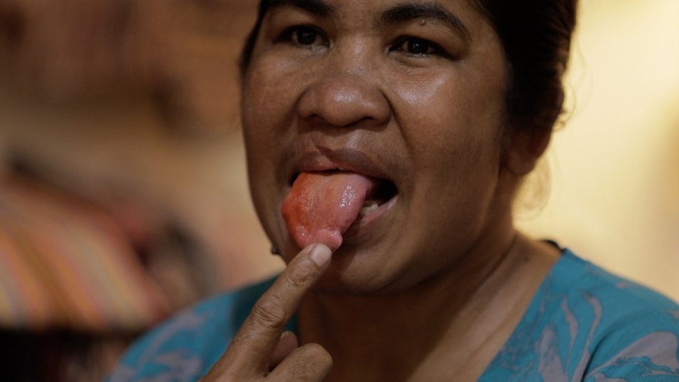 Meriance Kabu menunjukkan luka di lidahnya.