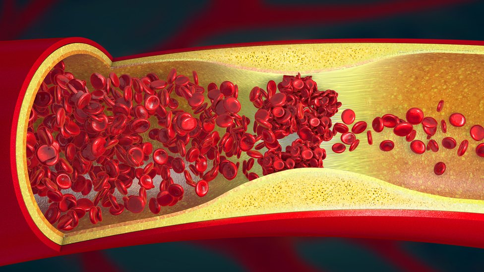 Ilustración de un coágulo de sangre.