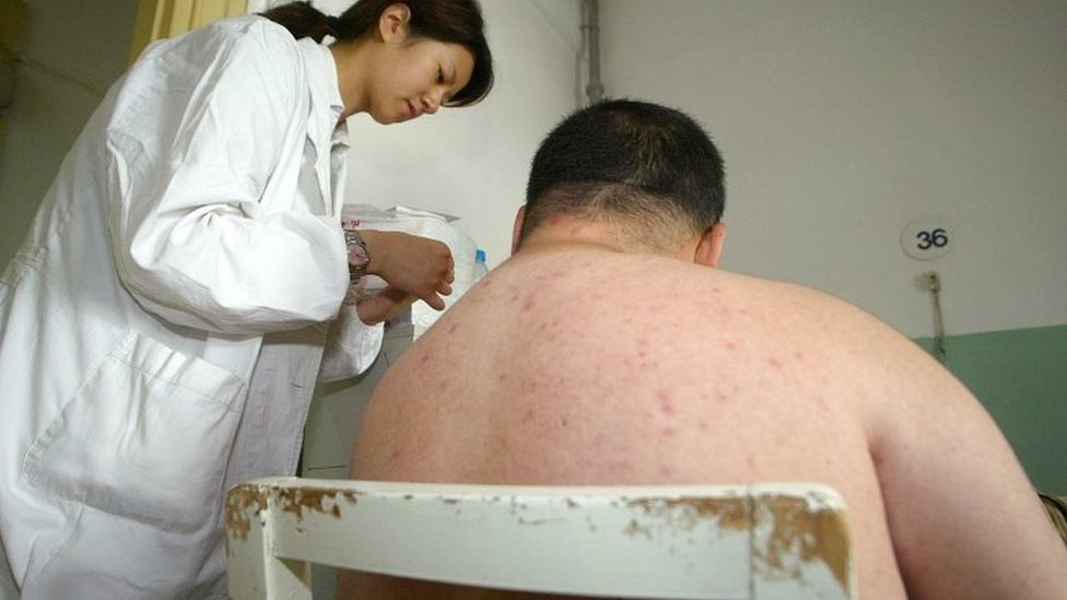 ШАНХАЙ, КИТАЙ: Врач лечит пациента с ожирением в больнице в Шанхае, 25 мая 2004 г.