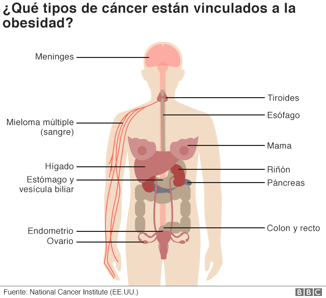 Gráfico del cuerpo humano y los órganos afectados por el cáncer asociado a la obesidad