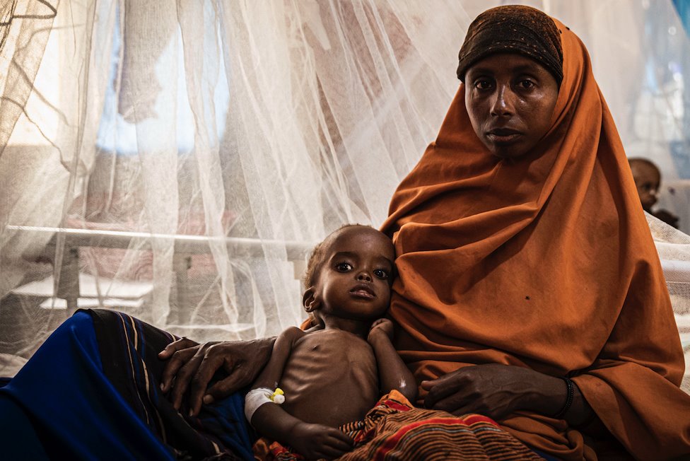 食物短缺導致索馬里許多兒童出現健康問題。