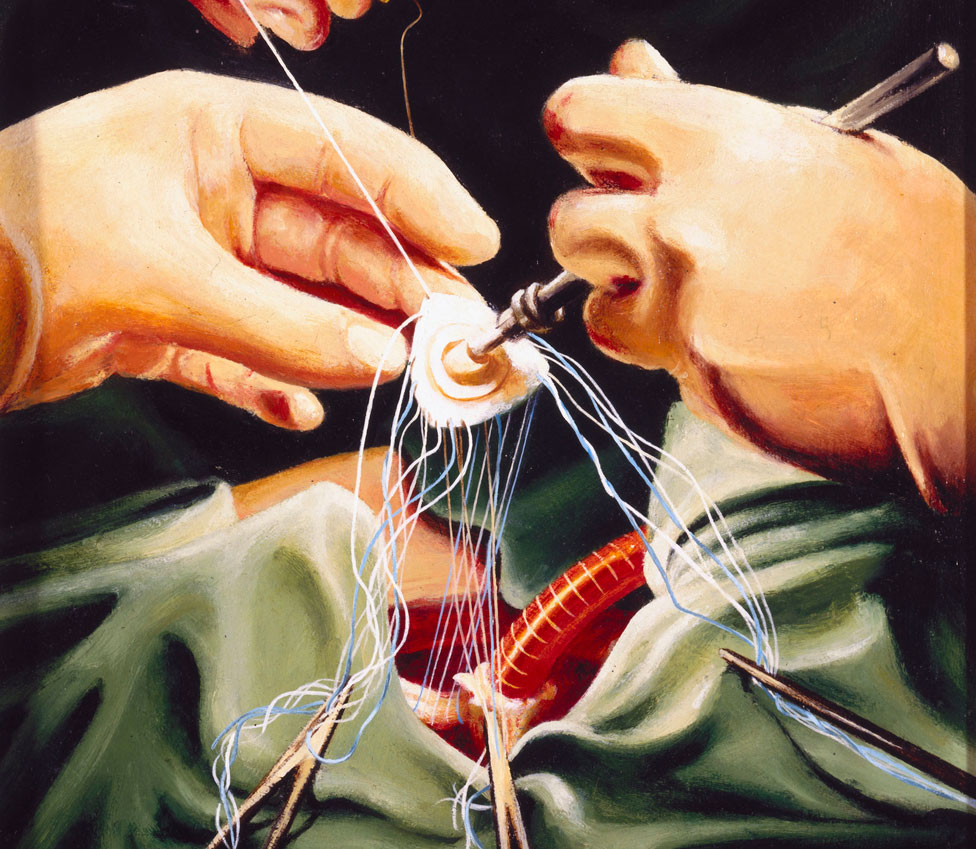 Un cuadro de Keith Holmes que muestra las manos del doctor Stephen Westaby durante una cirugía de corazón.