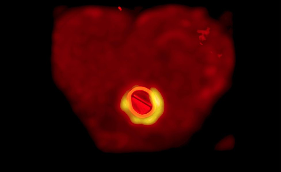 Сканирование сердца снизу с металлическим сердечным клапаном