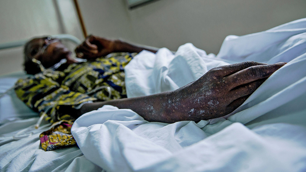 Paciente con VIH/sida en la República Democrática del Congo