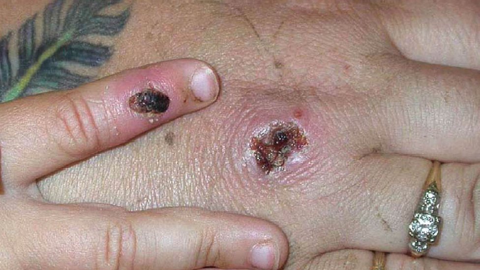 Scabs on a person's hands due to monkeypox.