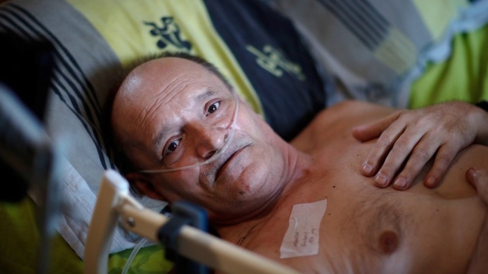 57 yaşındaki Alain Cocq, atardamar duvarlarının zarar gördüğü nadir bir hastalığa yakalandı.
