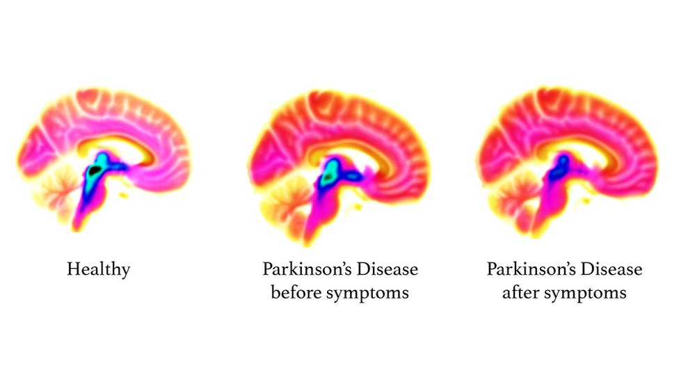 Визуализация мозга показывает потерю функции серотонина (синие / черные области) по мере прогрессирования болезни Паркинсона