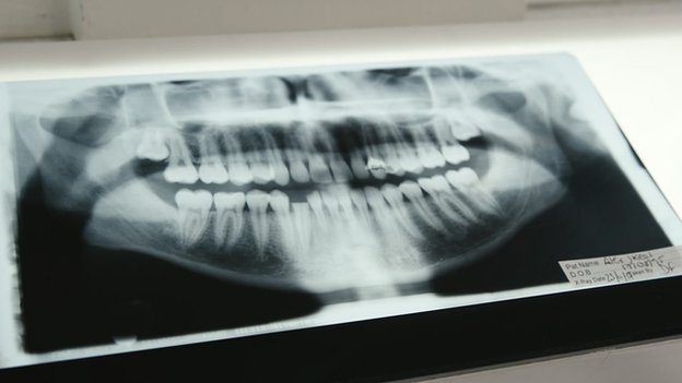 Radiografía de Alex mostrando dientes rotos.