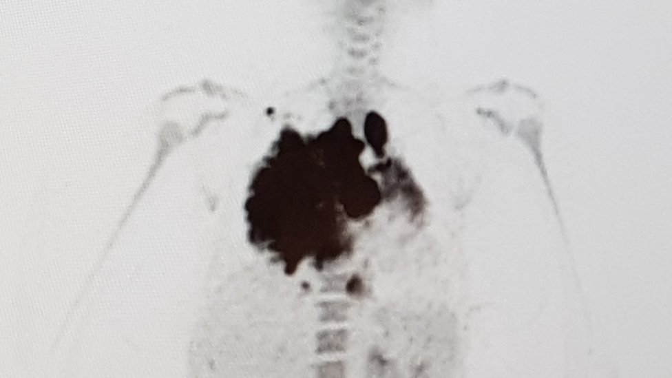 Сканирование, показывающее большую массу в груди Кэтрин