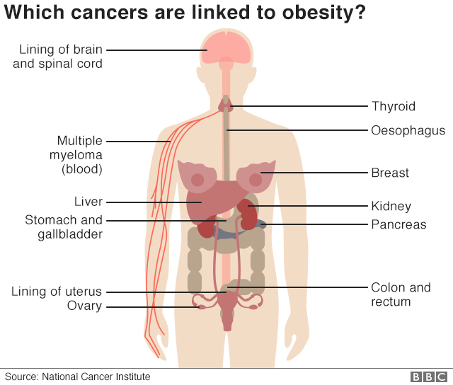 На инфографике изображено женское человеческое тело и указаны части тела, где ожирение связано с раком