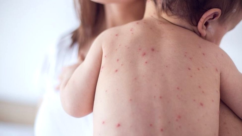 Un niño con varicela