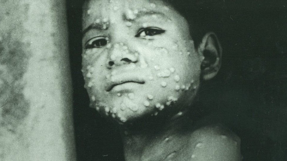 Foto histórica de un niño con sarampión