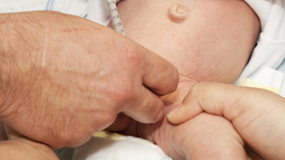 Un bebé sometido a una circuncisión quirúrgica.