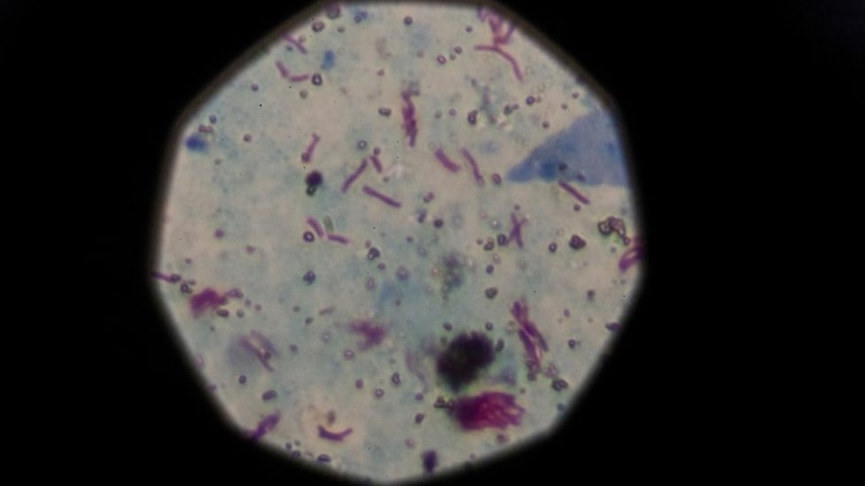 Образец с положительным результатом на туберкулез виден под микроскопом в Буэнос-Айресе, Аргентина, 29 марта 2019 г.
