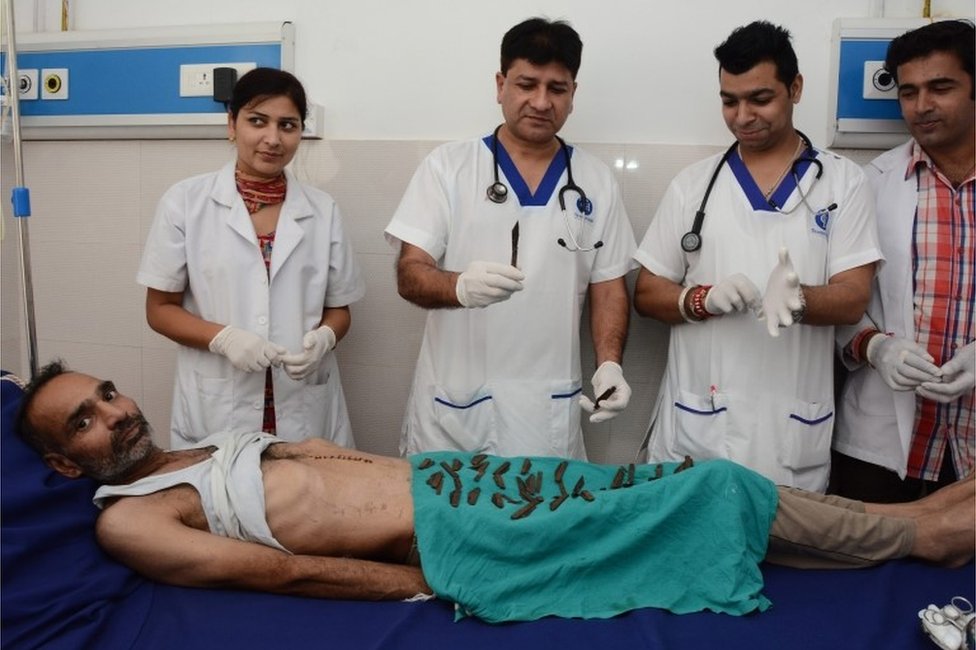 Indijac nakon operacije zahvaljujući kojoj mu je izvađeno 40 noževa iz stomaka