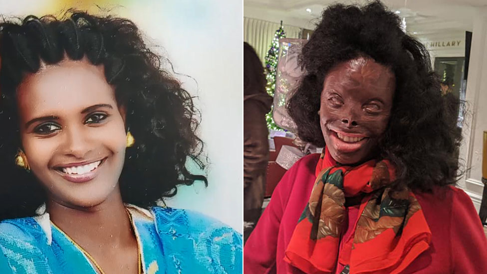 Ацеде Нгусе получила серьезные ожоги кислотой в результате нападения мужа