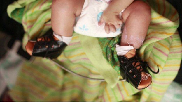 Canvassing Support Helping Children With Clubfoot c News